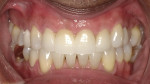 Final treatment photo following orthodontics
and restoration of upper central incisors.