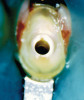 Figure 4  Caries present in tooth No. 18 and sealant of tooth No. 19 with suspected caries along margins.