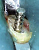 Figure 5  Caries present in tooth No. 31 and sealant of tooth No. 30 with suspected caries along margins.