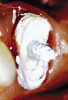 Figure 1  Preoperatively, the patient‚Äôs smile showed a full gingival display and asymmetrical gingival levels in the maxillary anterior region. Although the ‚Äúgummy smile‚Äù may not be able to be eliminated completely, better symmetry of the tissue levels was one of the goals of treatment.