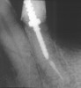 Figure 3  A gingivectomy was performed using an Er,Cr:YSGG laser to harmonize the soft-tissue levels. Biologic width was encroached upon and, therefore, a repositioning of the bony crest was also needed to prevent a relapse of the preoperative tissue position.