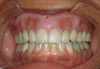 Figure 12  Six months after surgery, the patient‚Äôs full smile showed improvement in gingival symmetry and the gingival papilla between tooth Nos. 8 and 9 had completely reoccupied the gingival embrasure space.