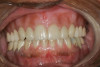Figure 13  Preoperative view of a fixed partial denture that spanned anteriorly from tooth No. 18 to tooth No. 21. There was a minor biologic width encroachment on the distal aspect of the anterior abutment, tooth No. 21. The anterior abutment also had recurrent facial decay apical to the restorative margin and a lack of attached gingiva on the facial aspect.