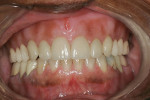Figure 2  Frontal view of maxillary Turbyfill denture.