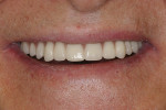 Figure 6  Postoperative smile with both overdentures in place.