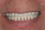 Figure 17  Postoperative smile with lower overdenture in place.