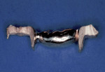 Figure 3  Two-piece cast-gold inlay bridge connected.