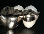 Figure 5  Distal section of cast-gold, stress-broken bridge with full crown and inlay abutment (laboratory work by Dr. Warren Johnson; Seattle, Washington).