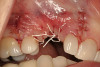 Figure 14  Lingual composite veneers tried in mouth.