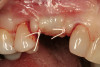 Figure 20  Composite placed in clear RSVP PVS impression.