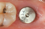 Fig 8. Type C extraction socket (Fig 7); a wide-diameter (8 mm x 9 mm) implant at 1 week postoperative healing (Fig 8); final restoration inserted (Fig 9); 5-year postoperative CBCT (Fig 10).