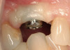 Figure 24  Ultra-Etch placed on second molar using a Brasseler metal saw to protect adjacent teeth.