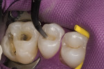 Figure 1  After amalgam removal, teeth Nos. 3 and 4 are isolated, and a chlorhexidine rinse is used to clean the sites.