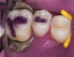 Figure 2  An acid etchant is placed to condition the tooth surfaces for the TE procedure.