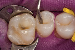 Figure 5  The buccal increment of microhybrid resin is contoured to replicate the natural anatomy of the teeth.
