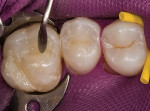 Figure 6  The lingual increment of Esthet-X® HD (DENTSPLY Caulk) is then placed and properly contoured.