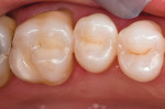 Figure 7  Postoperative occlusal view of the esthetic direct resin restorations performed using the TE approach.