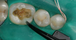 Figure 8  After removal of an amalgam restoration, tooth No. 19 has been isolated and the cavity is cleaned with chlorhexidine prior to adhesive bonding.