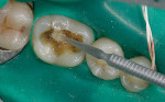 Figure 9: After proper conditioning of the prepared restorative site, an SE adhesive is applied for direct resin bonding