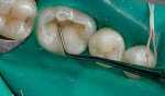 Figure 10  A flowable composite may first be placed on the floor of the cavity. An increment of microhybrid composite is applied to the lingual and then to the buccal walls of the cavity, and sculpted.