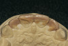 Figure 1a  A patient presents with large direct composite restorations and multiple crack lines in teeth Nos. 18 and 19. Tooth No. 19 was symptomatic to biting pressure.
