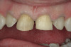 Figure 1c  The final restorations restore and protect the compromised cusps.