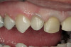 Figure 2  The occlusal surface of the tooth is reduced to provide 2 mm of porcelain thickness in the definitive restoration.