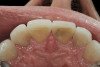 Figure 5  A chamfer is established on the facial aspect of the preparation to create an esthetic transition at the tooth/ceramic interface.