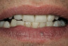 Figure 6b  Tooth No. 19 is compromised axially on the mesiolingual, but a great deal of structural integrity still remains on the facial aspect of the tooth. The tooth is prepared for an adhesively retained restoration.