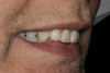 Figure 6c  The final restoration addresses the occlusal, proximal, and lingual compromises of the tooth yet preserves facial tooth structure.