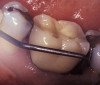 Figure 7a  Teeth Nos. 4, 5, and 30 were in need of indirect restorations and were treatment planned for all-porcelain, adhesively retained restorations.