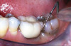 Figure 9b  At the time of delivery of the definitive restoration, the provisional restoration is removed and the preparation is cleaned using low-pressure particle abrasion.