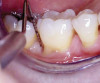 Figure 9d  A 35% phosphoric acid is agitated on the prepared tooth for 15 seconds.