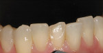 Figure 1  CLINICAL RESULTS  An example of what SE Protect and one shade of Majesty Esthetic can do on a day-to-day basis.