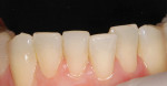 Figure 2  CLINICAL RESULTS  An example of what SE Protect and one shade of Majesty Esthetic can do on a day-to-day basis.