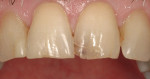 Figure 3  CLINICAL RESULTS  An example of what SE Protect and one shade of Majesty Esthetic can do on a day-to-day basis.