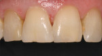 Figure 4  CLINICAL RESULTS  An example of what SE Protect and one shade of Majesty Esthetic can do on a day-to-day basis.