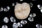 Figure 1  Zir-Max offers clinicians and patients beauty and strength in full-coverage molar and premolar restorations.