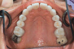 Fig 8. Postoperative occlusal view of maxillary dentition.