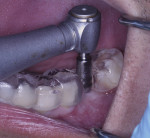 Fig 6. Tissue punch being used to create a minimally invasive incision.