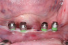 Figure 2  Axial view showing defects on facial before grafting.