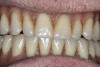 Figure 6  Clinical view of the maxillary ridge healing after graft placement.