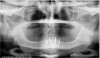 Figure 7  Six-month post-graft CBCT axial view showing substantial bone growth from graft.