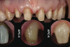 Figure 12  Post-placement panographic revealing implant positions.