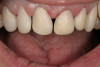 Figure 14  Panographic view showing large facial bone defects.