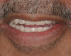 Figure 3  Compare and Contrast, Pre-extraction dentate state.