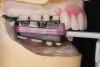 Figure 6  Compare and Contrast, Completed maxillary implant bar-overdenture.