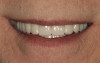 Figure 7  Compare and Contrast, Existing dentures.