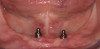Figure 8  Compare and Contrast, Revised complete dentures with similar tooth form, slightly larger tooth size, higher value, increased occlusal-vertical dimension, and improved tooth position.