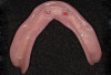 Figure 9  Square Form, Complete maxillary and mandibular dentures. .